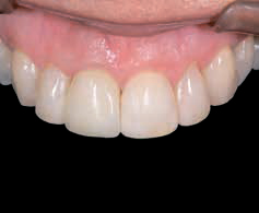 Готовый зубной протез из пластмассы Luxatemp PLUS